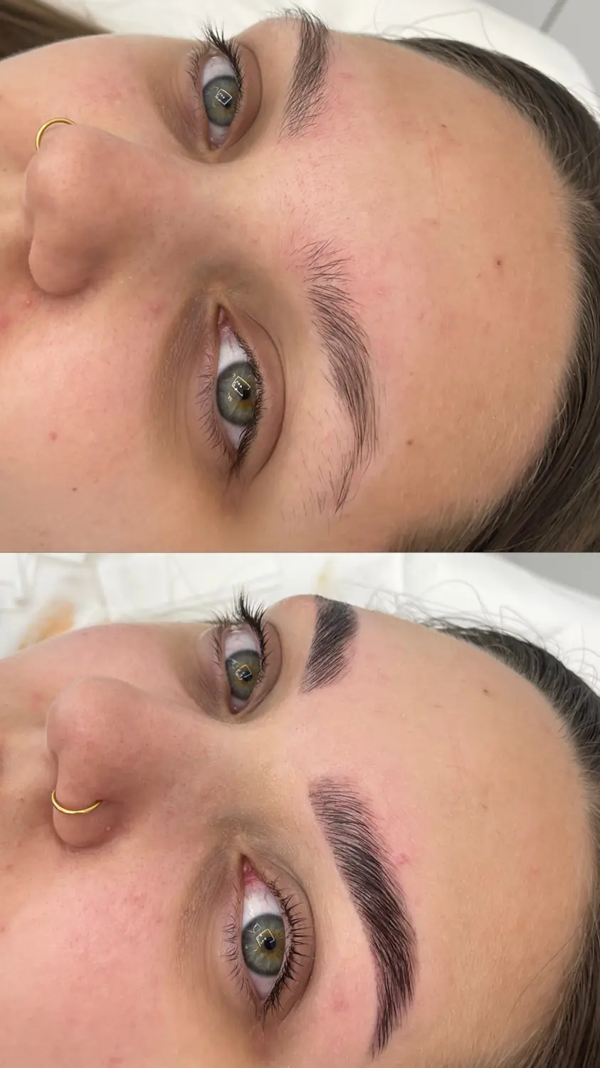 Brow lift — fotografija 1