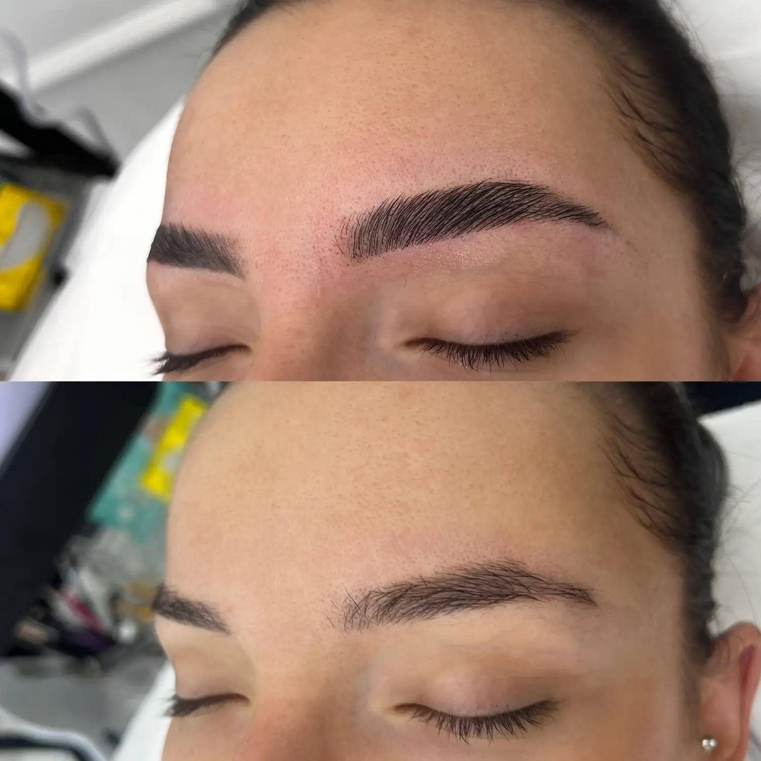 Brow lift — fotografija 2