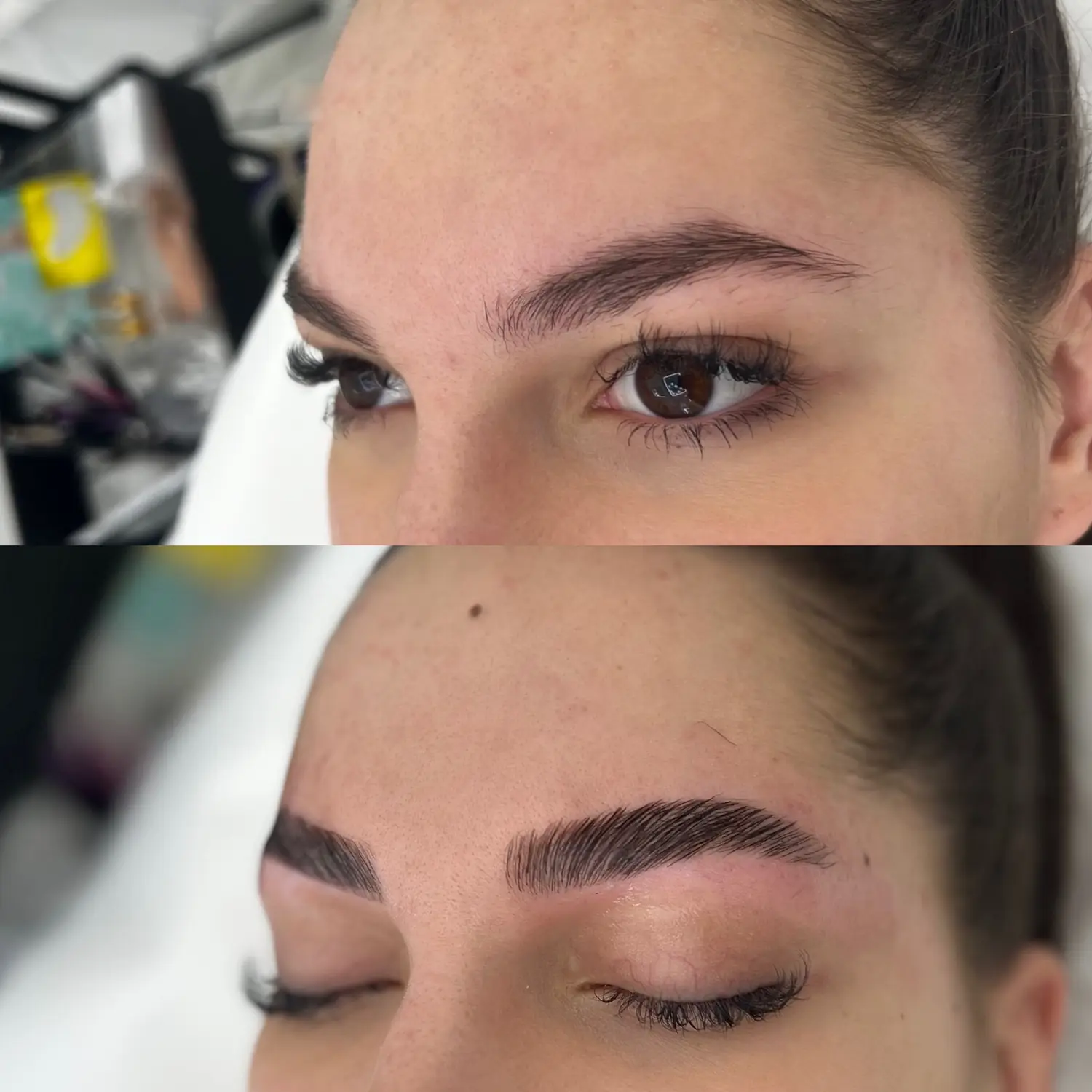Brow lift — fotografija 3