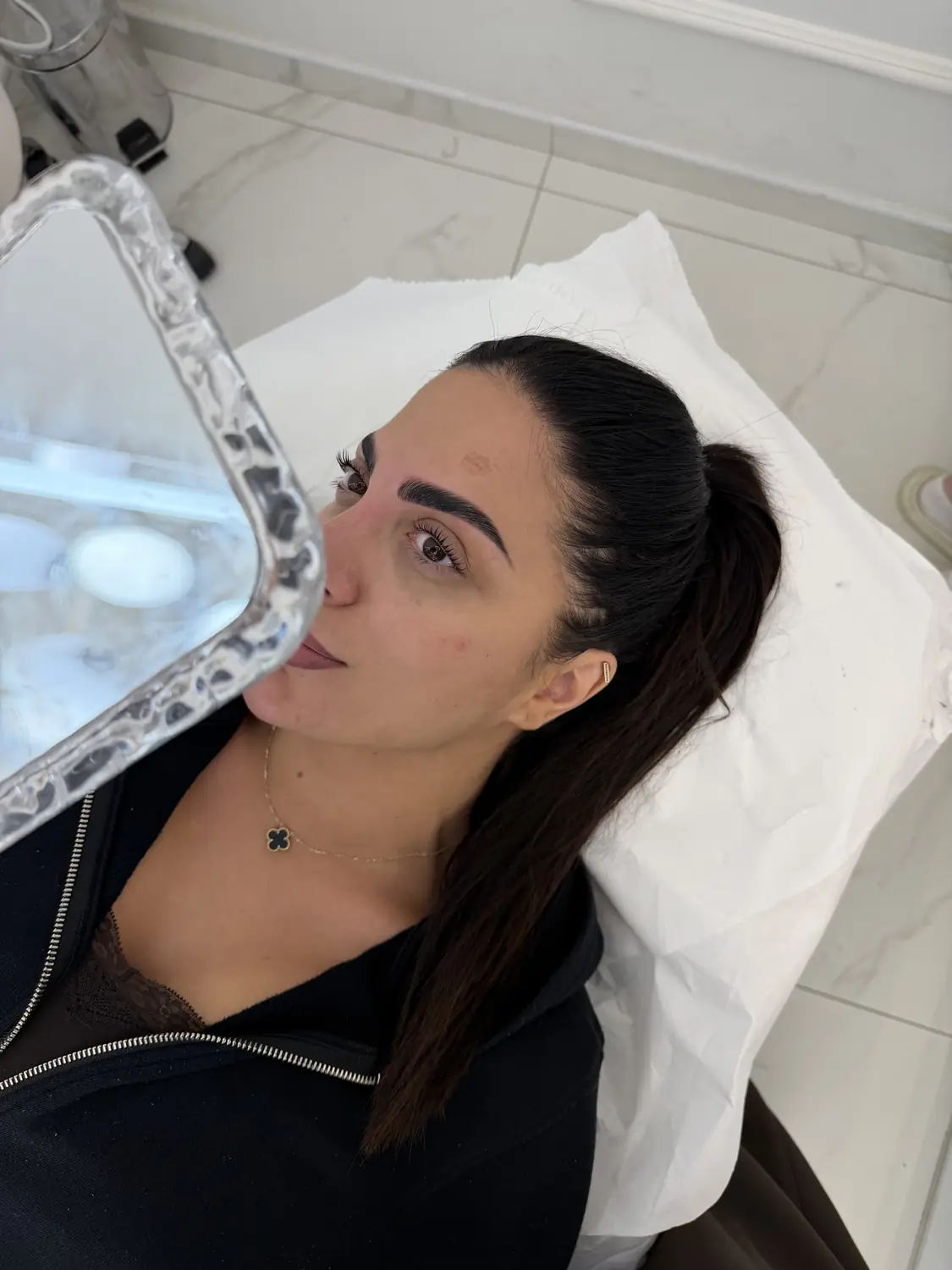 Brow lift — fotografija 5