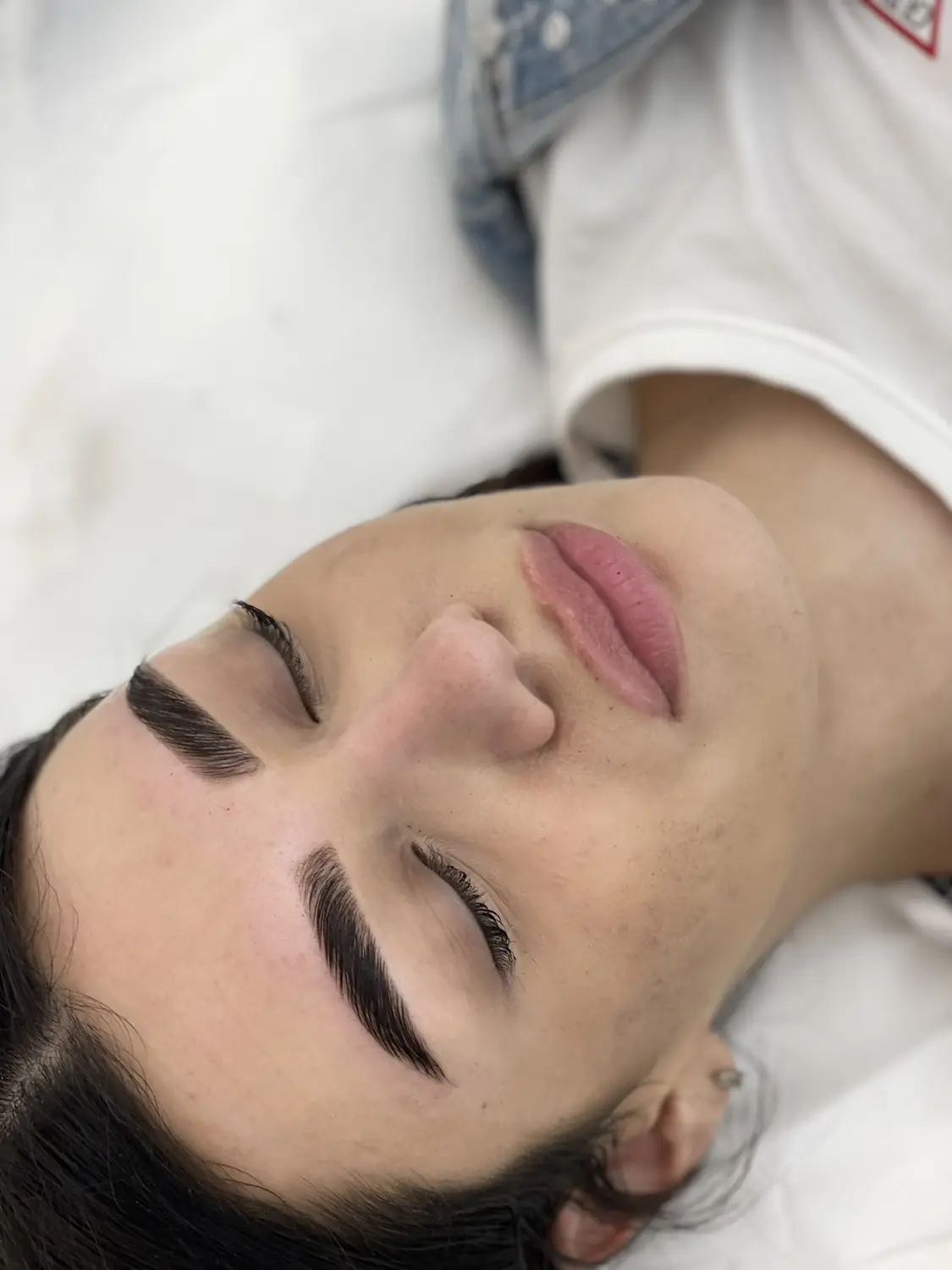 Brow lift — fotografija 7