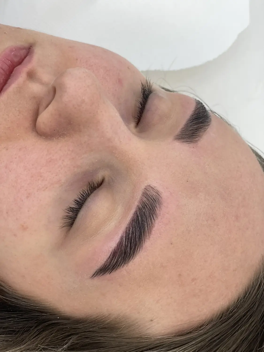 Brow lift — fotografija 8