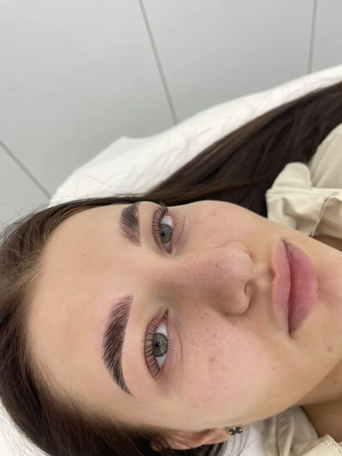 Brow lift — fotografija 9